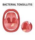 Bacterial and viral tonsillitis. Angina, pharyngitis, and tonsillitis.